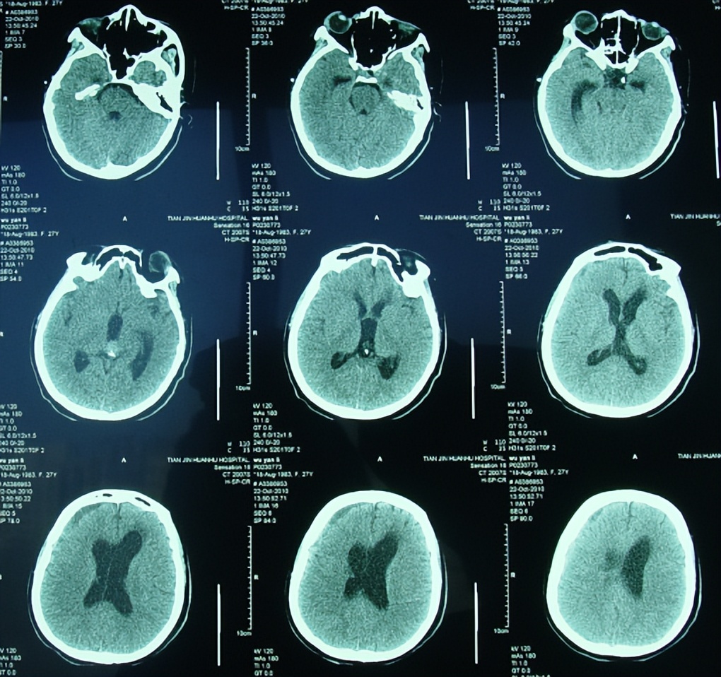 月13日(脑室镜第三脑室造瘘术后58天),脑ct显示的脑室再次扩大(图-13)