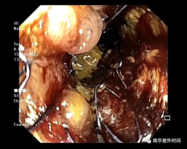 左半結腸癌性腸梗阻的微創治療腸道支架sems植入術