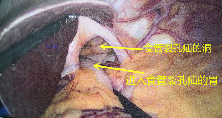 食管裂孔疝A环图片