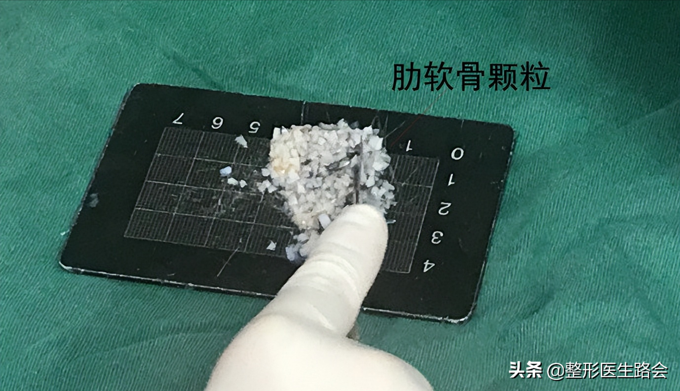 但是,取肋軟骨會給求美者帶來多餘的損傷,疼痛和疤痕.