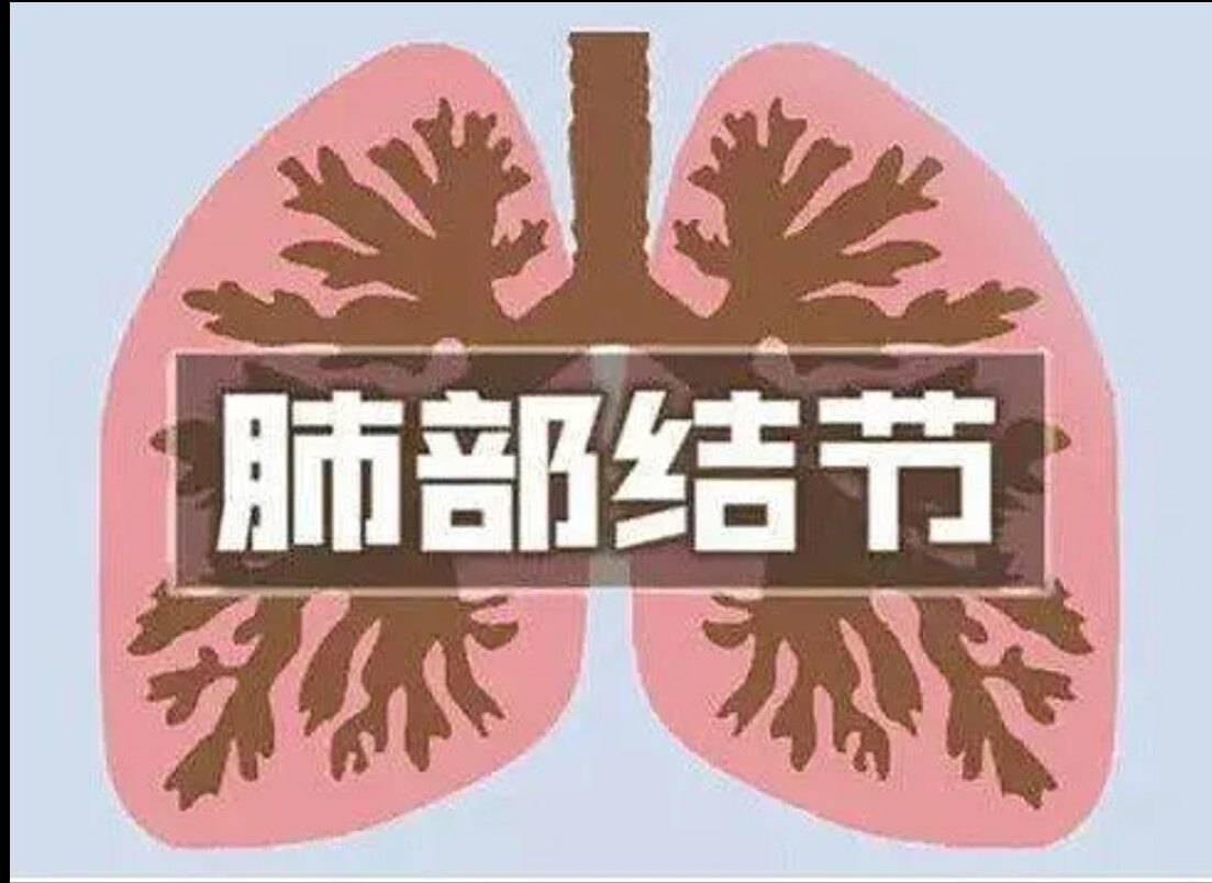 磨玻璃结节 磨玻璃结节