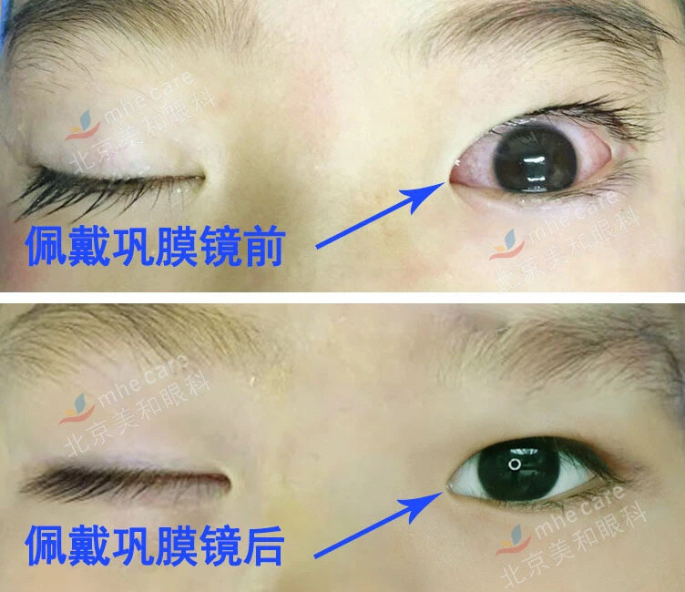 小睑裂综合综合征术前术后对比图如何解决孩子术后干眼问题?