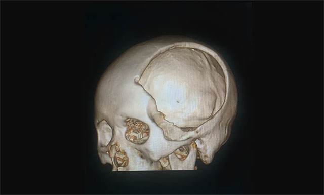 脑组织及血块,适合于一侧额区和颞前区的损伤合并对侧额叶底区挫裂伤