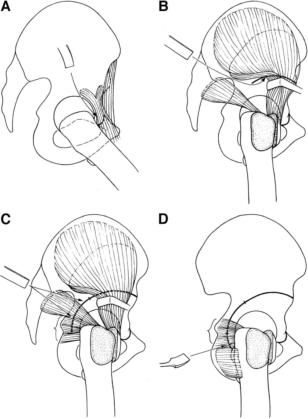 schematic drawings of the sequence of pao via a modified kocher