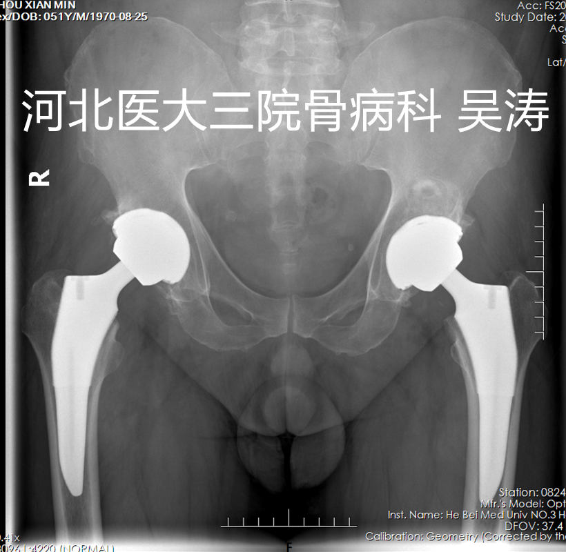 分次B 术后二次.png