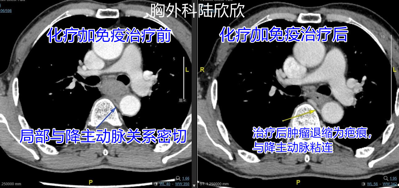 降主动脉粘连水印.jpg