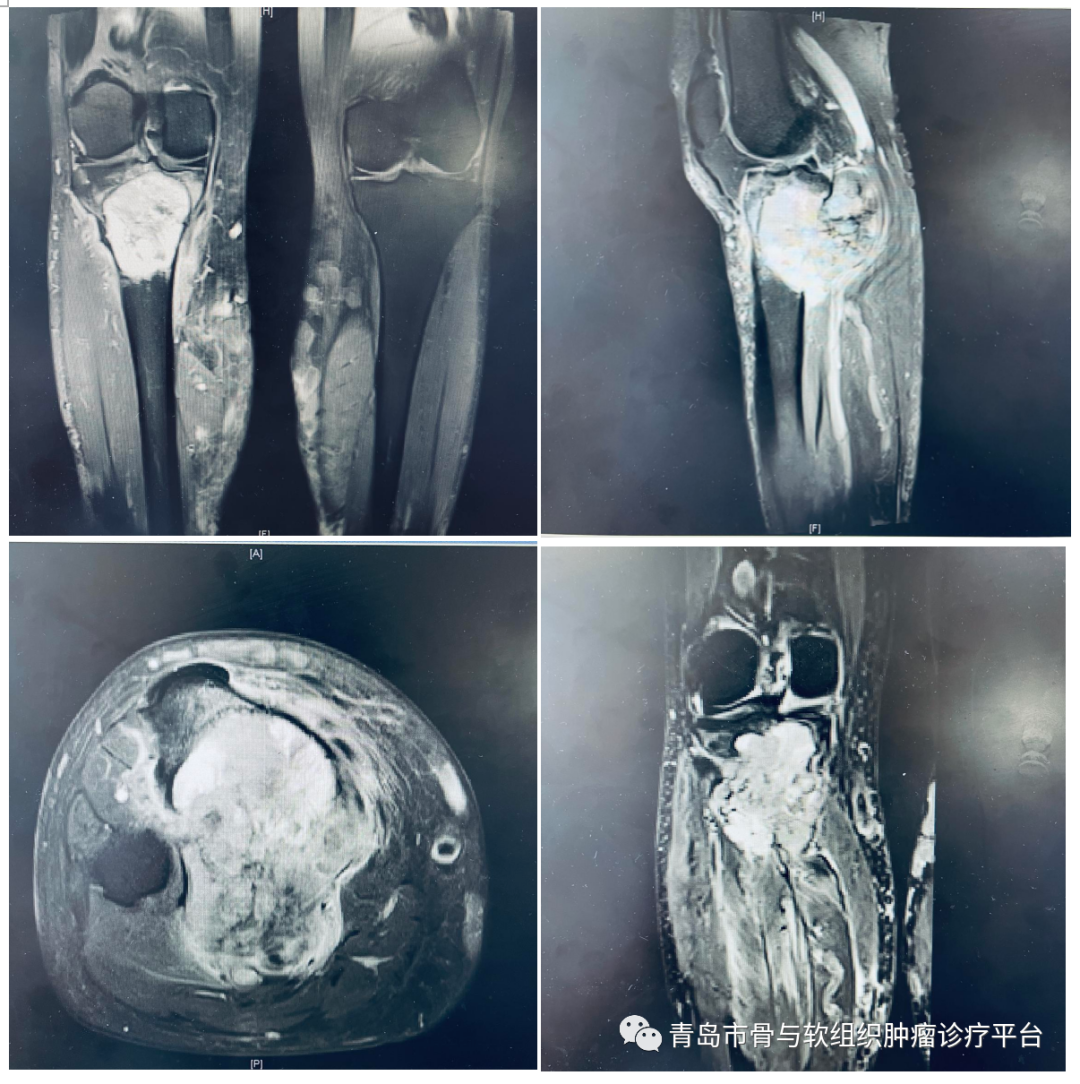 典型病例膝關節原發惡性骨腫瘤一期手術切除腫瘤型膝關節假體置換