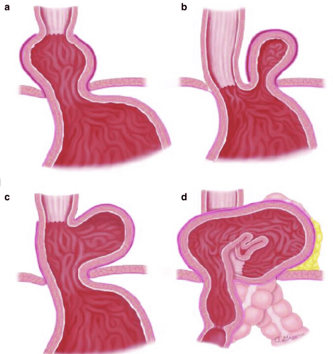 食管裂孔疝a环b环位置图片