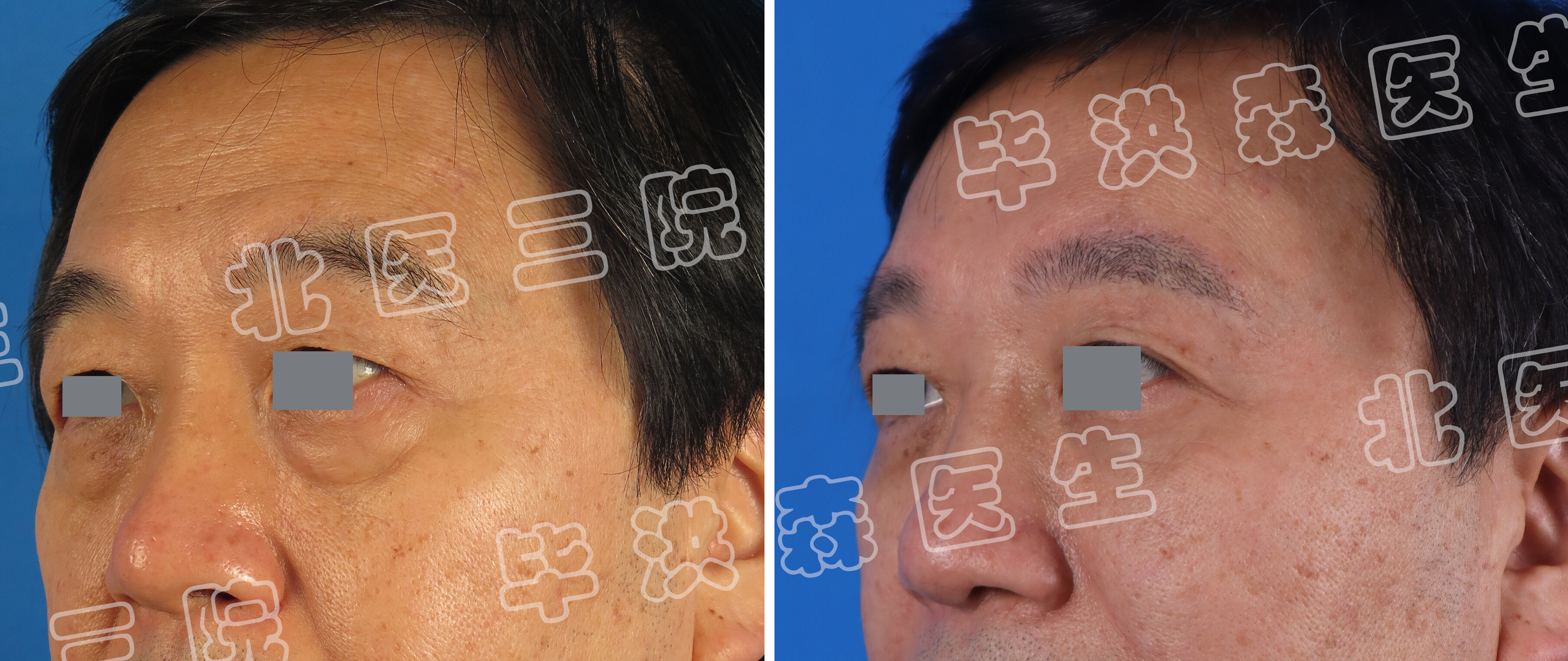 左45° 无表情-半脸.jpg