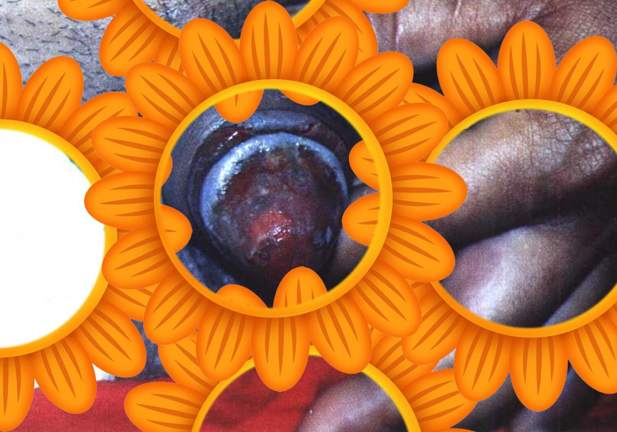 男人,别小看了包皮龟头炎?带你一文掌握!