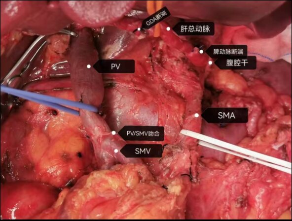 胰腺惡性腫瘤侵犯周圍血管的外科治療方案