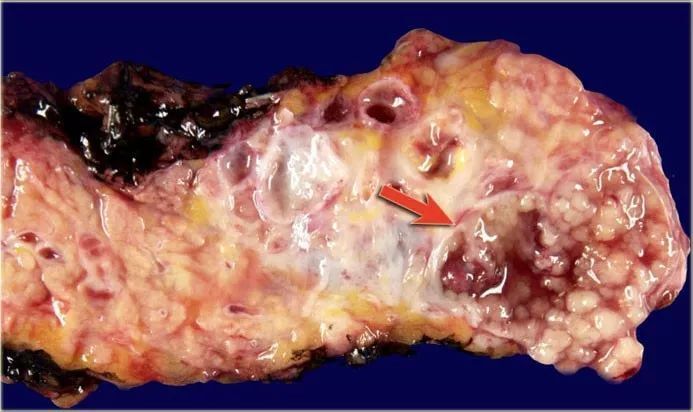 淺談胰腺導管內乳頭狀黏液性腫瘤(ipmn)_胰腺癌_介紹_治療方式 - 好