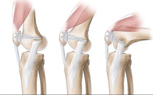 髌骨脱位韧带重建图片图片