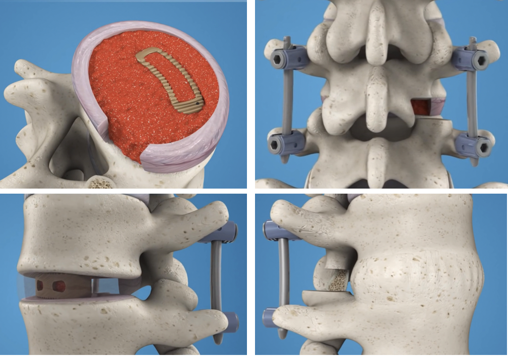什么是双通道镜下腰椎融合术_腰椎间盘突出_腰椎间盘突出治疗方式