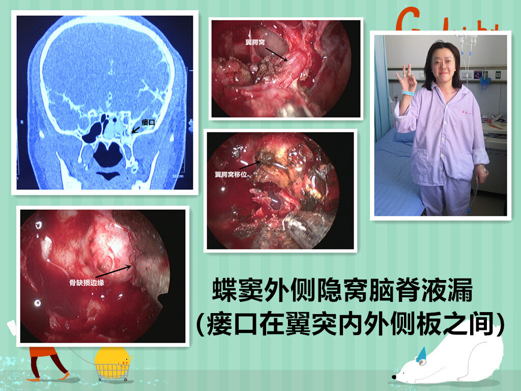 內鏡治療三種類型的蝶竇外側隱窩腦脊液鼻漏