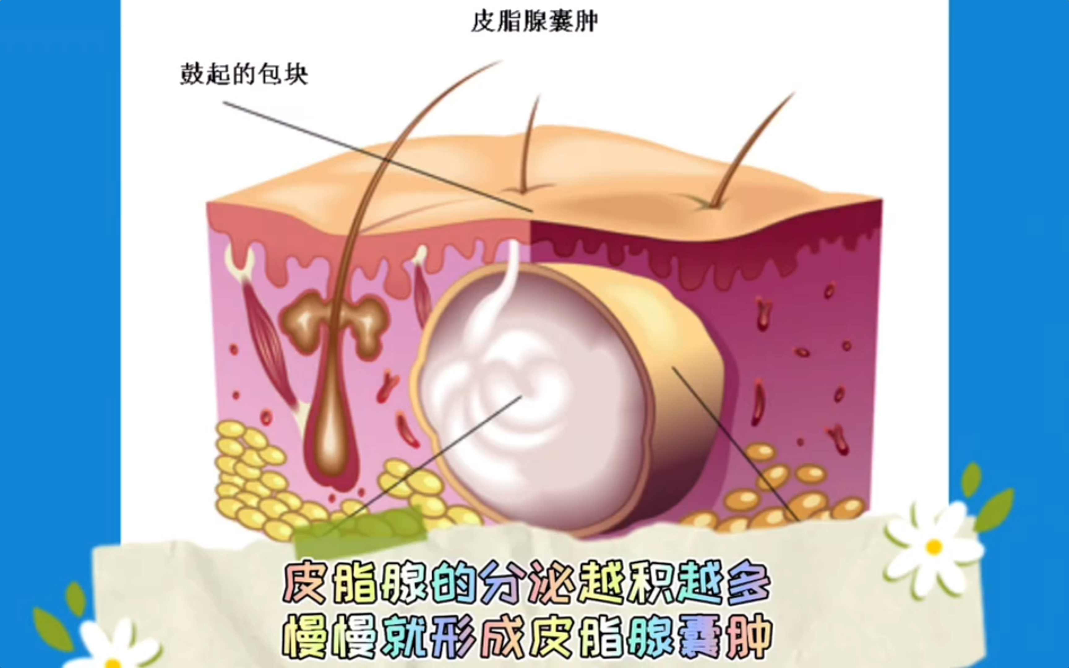 皮脂腺导管开口于毛囊