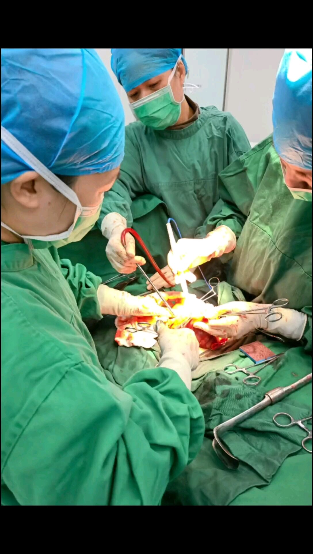 子宫肌瘤微创手术过程图片