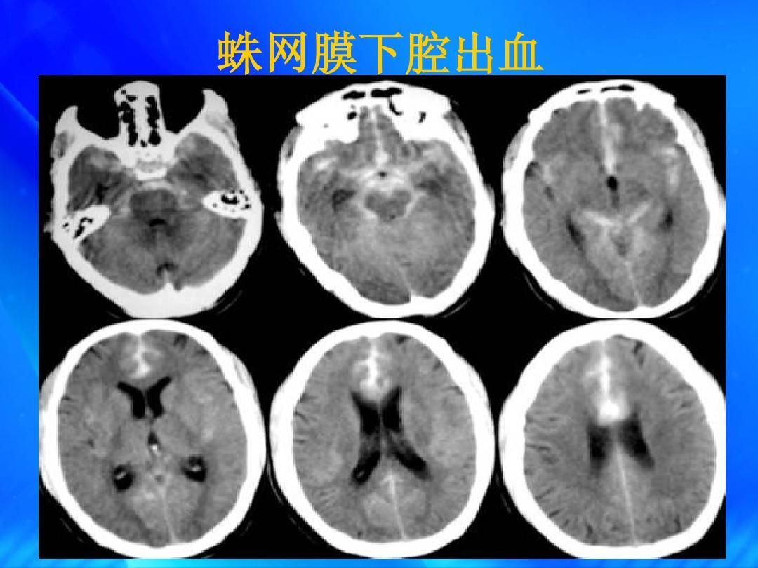 脑血管造影（DSA）是诊断蛛网膜下腔出血（SAH）的金标准， 为什么做了脑血管造影还是找不到病因？_蛛网膜下腔出血_发病原因_如何预防_检查-  好大夫在线