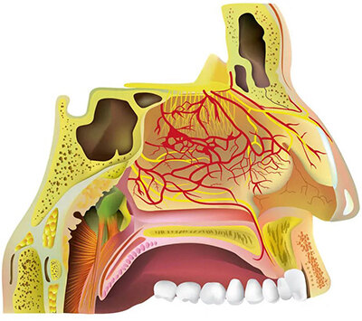 鼻腔炎症如鼻-鼻竇炎時的鼻腔黏膜充血,腫脹
