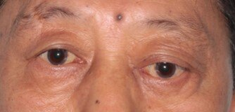 眼肿瘤系列科普:泪腺恶性肿瘤有哪些表现?图片来说明 
