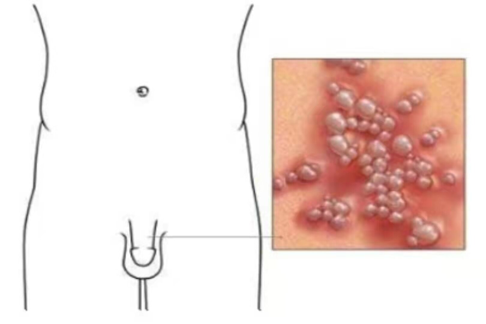 生殖器疱疹_介绍_发病原因_症状表现_治疗方式 好大夫在线