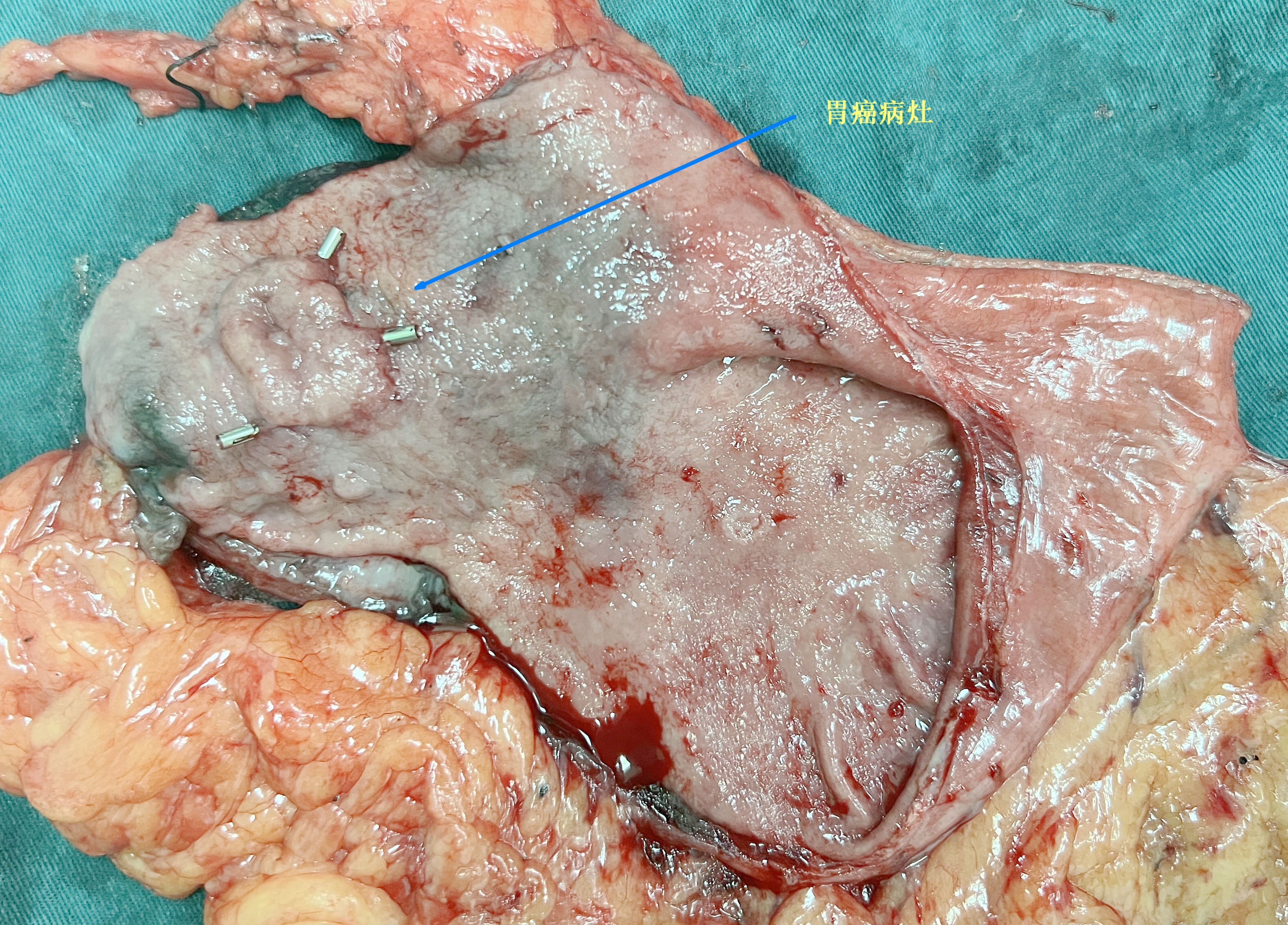 胃腺癌图片图片