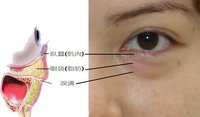 眼袋结构