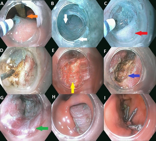 图文详解顽固性胃瘫治疗方法幽门括约肌切开术