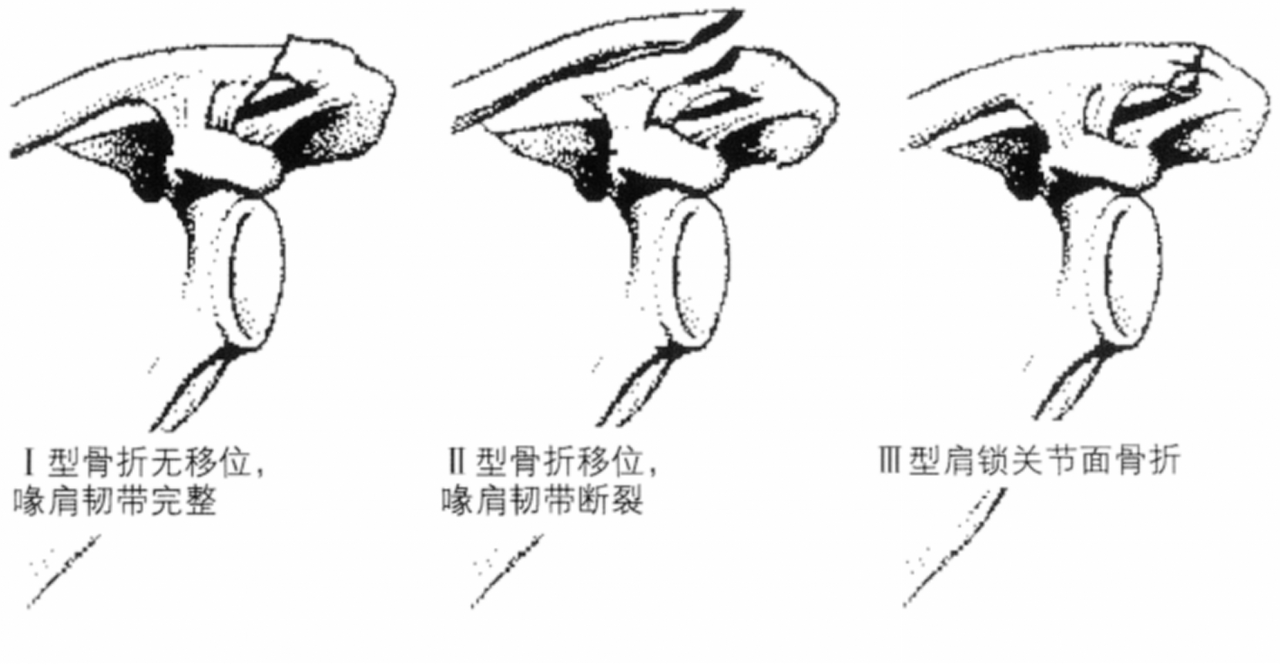 锁骨骨折分型图图片