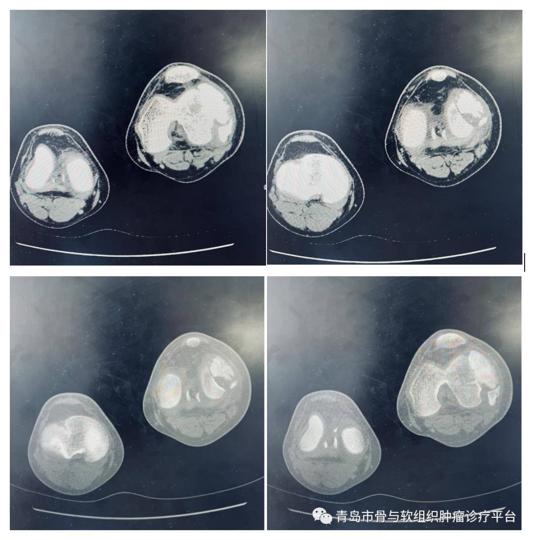 【典型病例】膝關節原發惡性骨腫瘤一期手術切除 腫瘤型膝關節假體