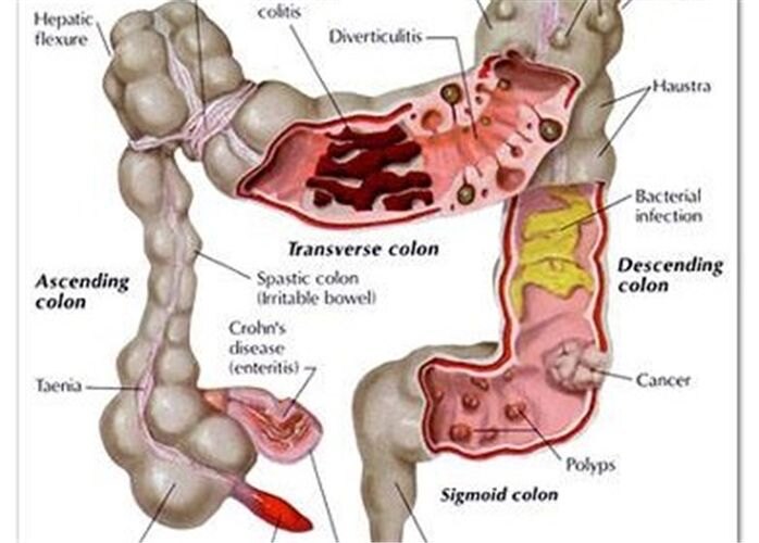 潰瘍性結腸炎_潰瘍性結腸炎症狀表現 - 好大夫在線