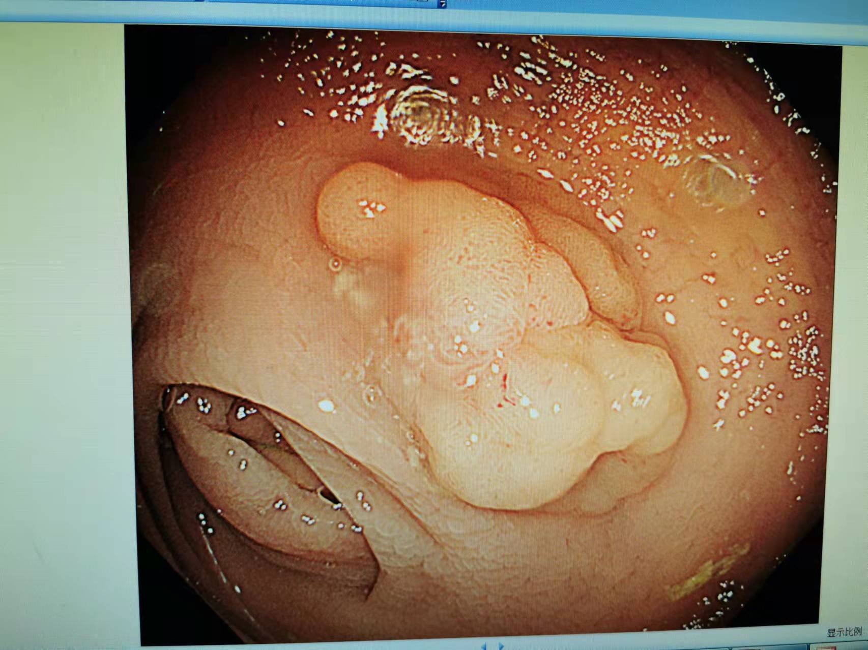 直肠腺癌图片肠镜图片
