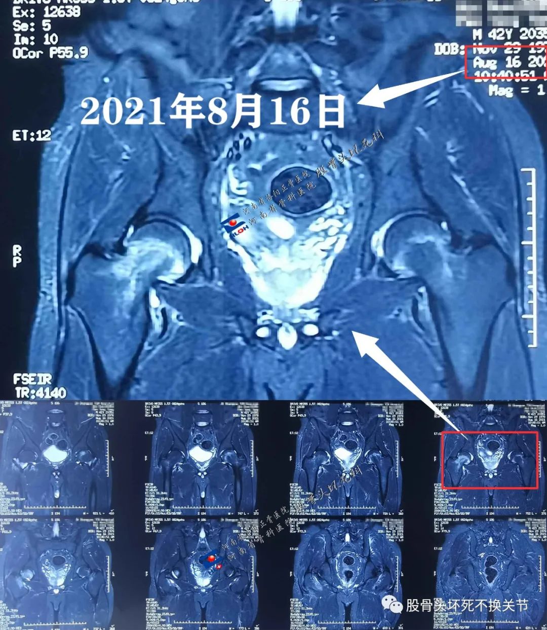 险些被"砍头"的股骨头骨髓水肿综合征 - 好大夫在线