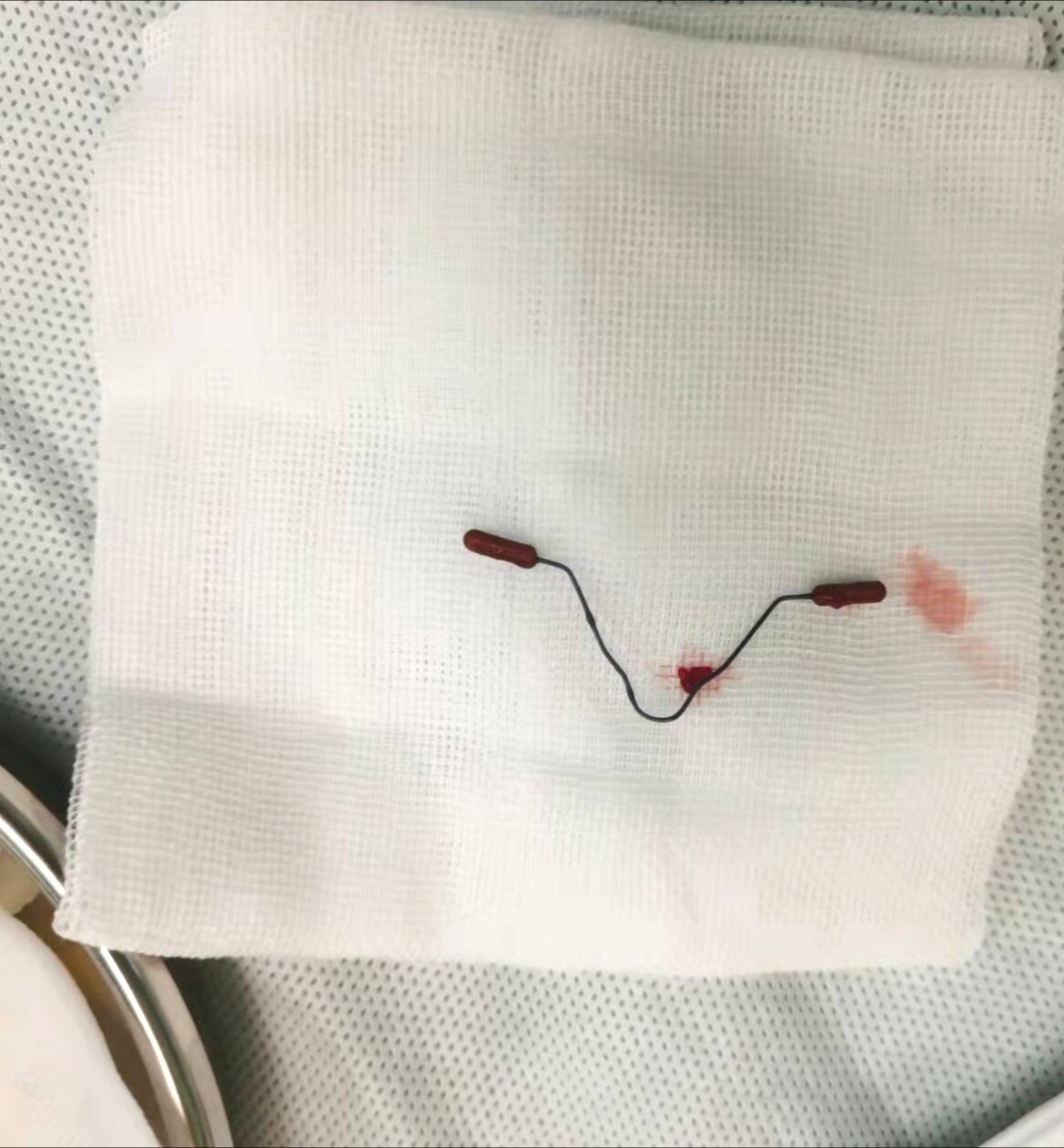 迷路的节育器———一例困难取环术的诊治经过