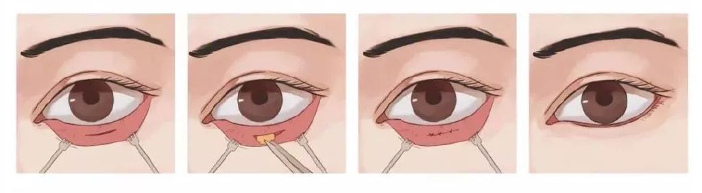 如何选择祛眼袋手术方式?