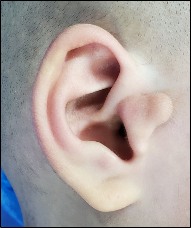 耳道狭窄图片