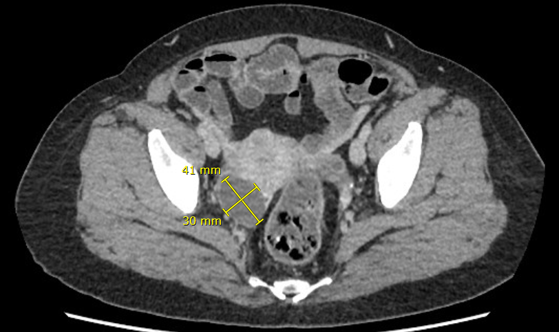 下腹部ct提示:右侧附件区囊性占位,考虑卵巢囊肿或囊腺瘤可能胆囊结石