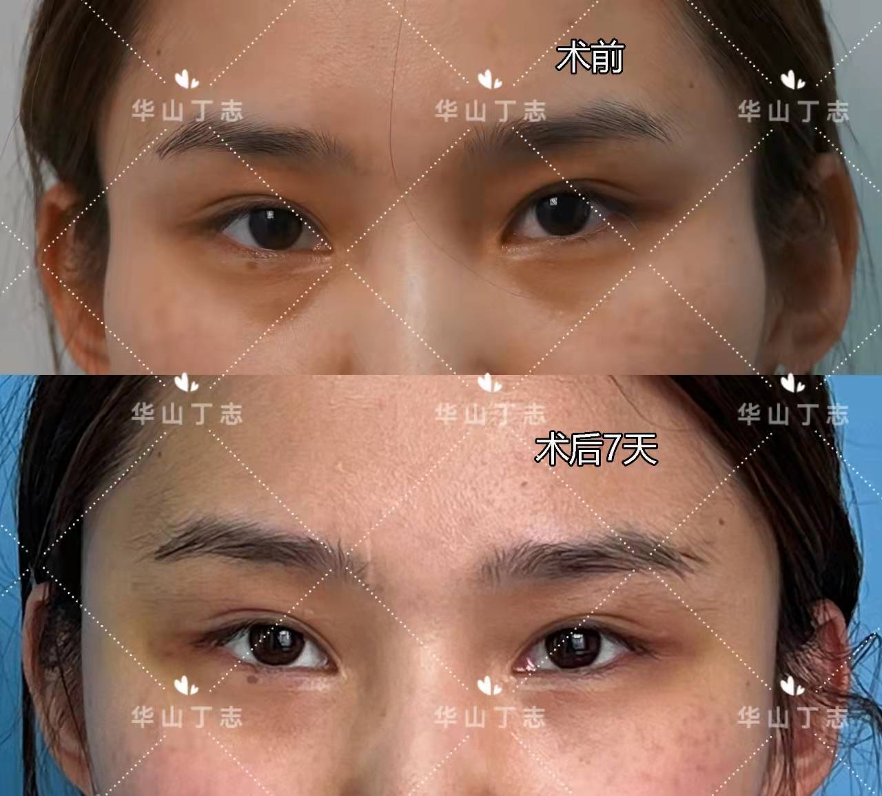 填充面部手术要多少钱_面部填充手术_填充面部手术视频