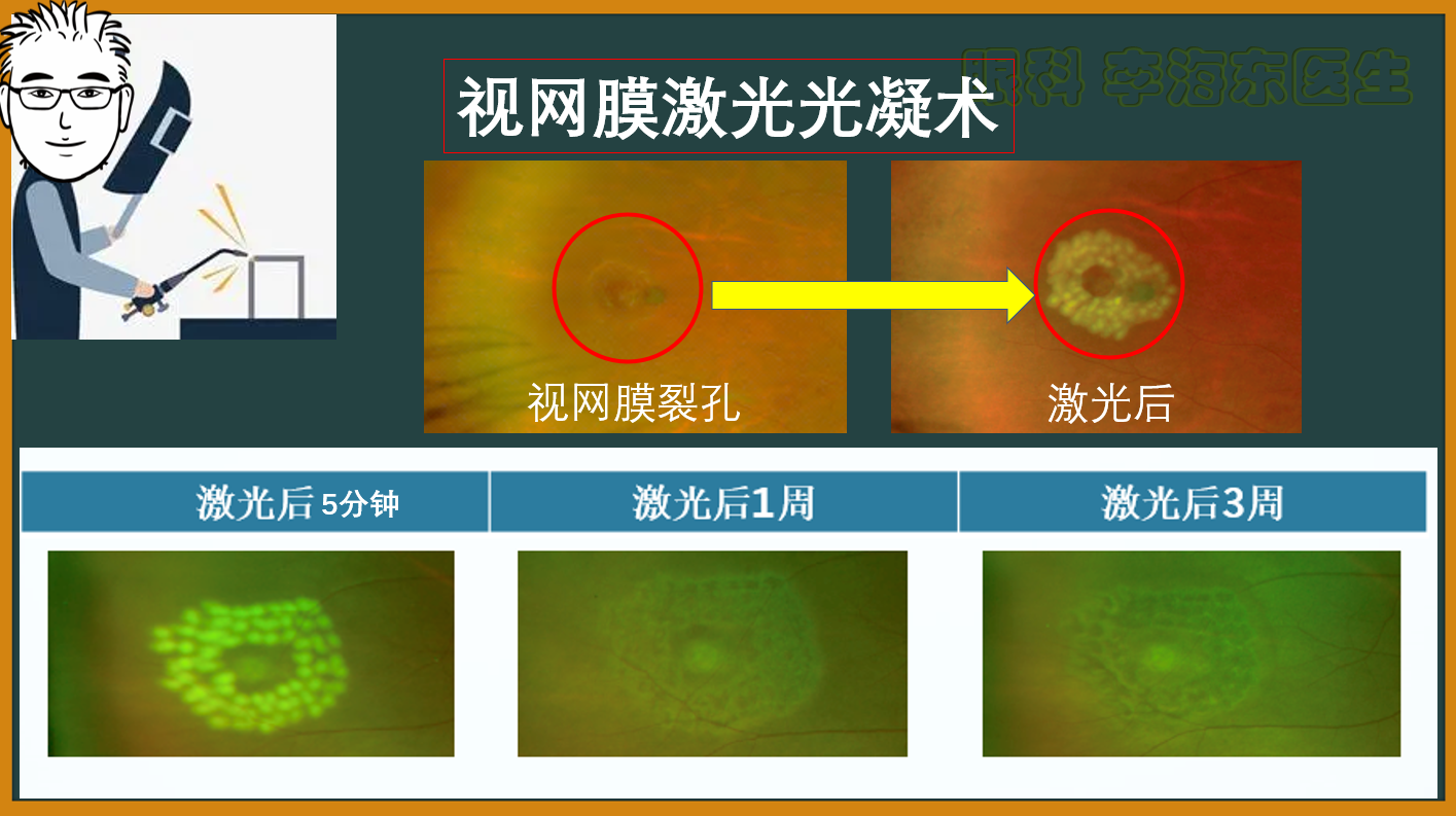 1视网膜激光光凝png