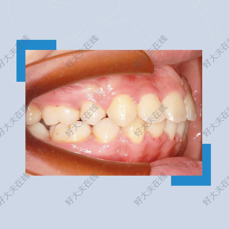 凸面型_正畸 - 好大夫在线