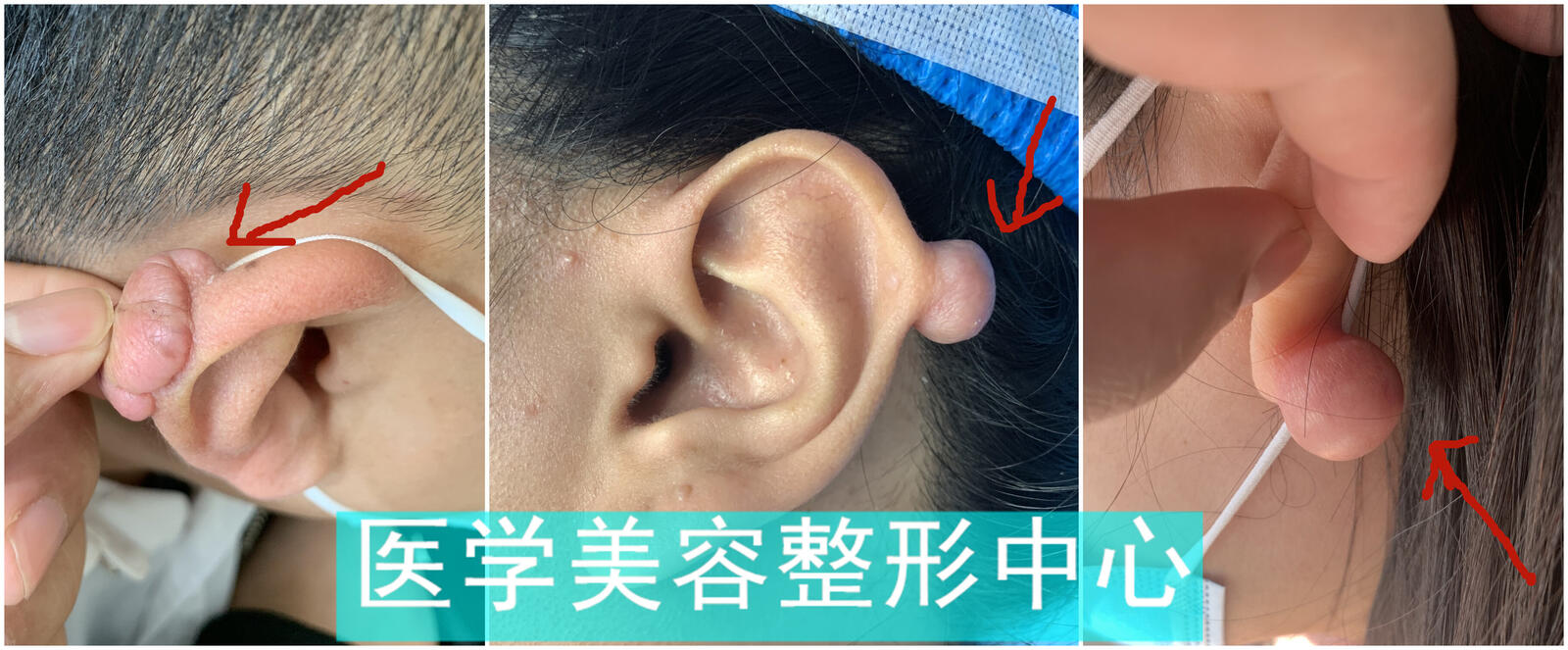 耳部瘢痕疙瘩亦为瘢痕疙瘩的一种,常见于耳垂,耳轮等部位,其质地坚硬
