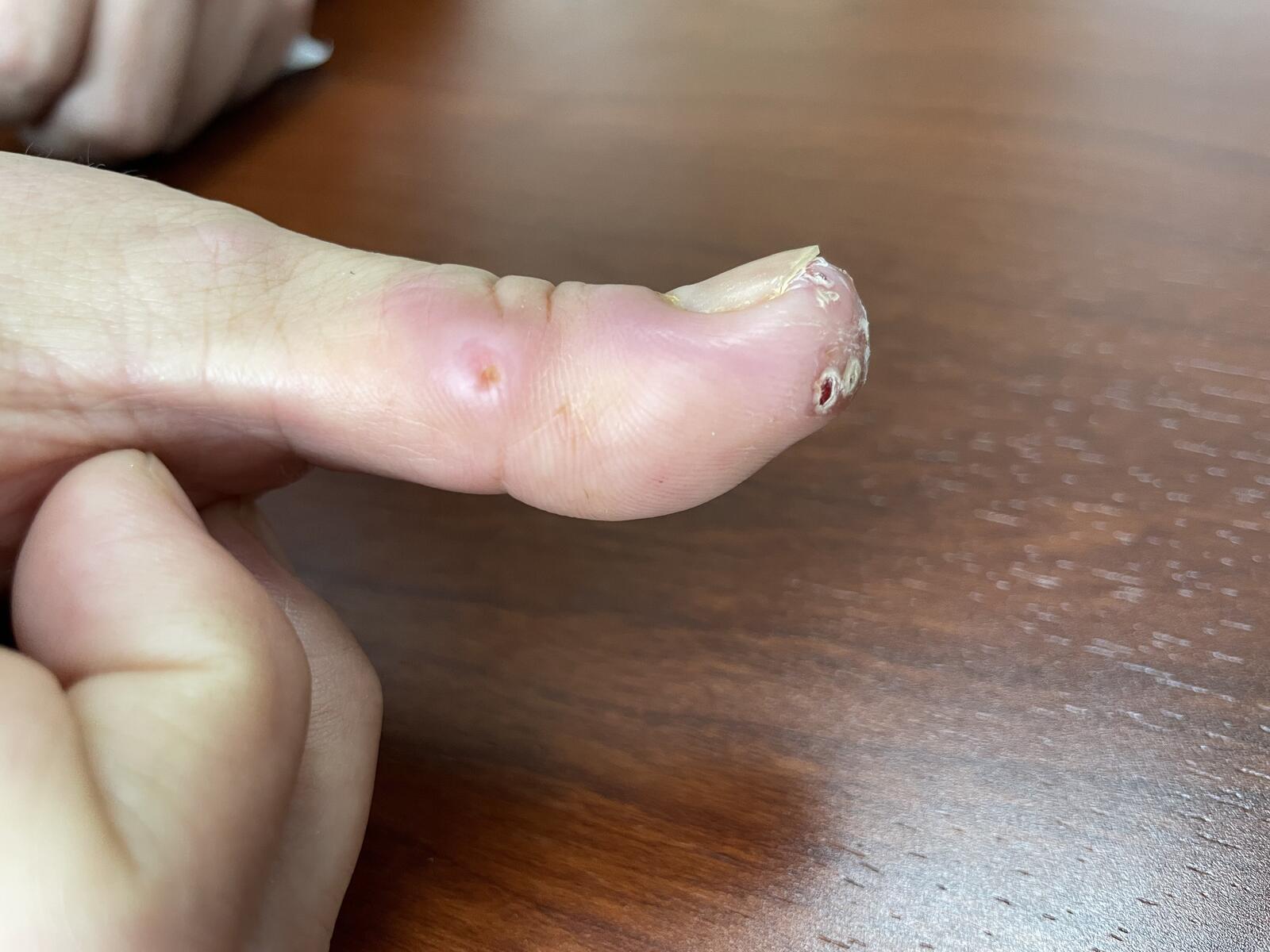 我手指被海鱼扎伤了,起了红疙瘩,治疗好几个月,也不见好,是怎么回事?