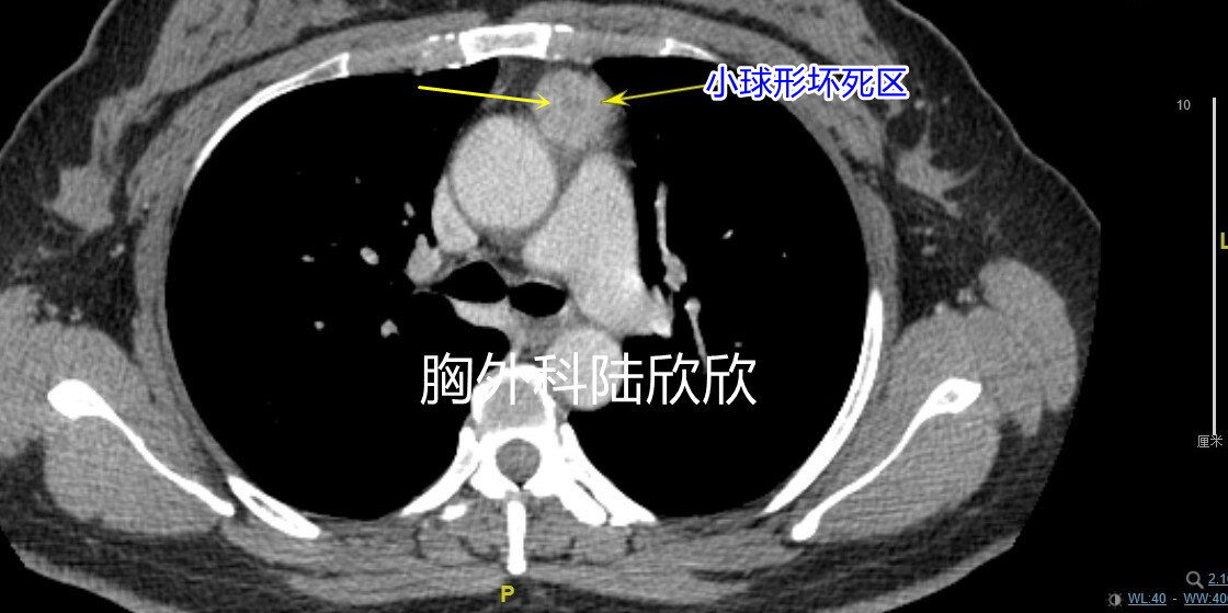 肿瘤中下极内部坏死区水印.jpg