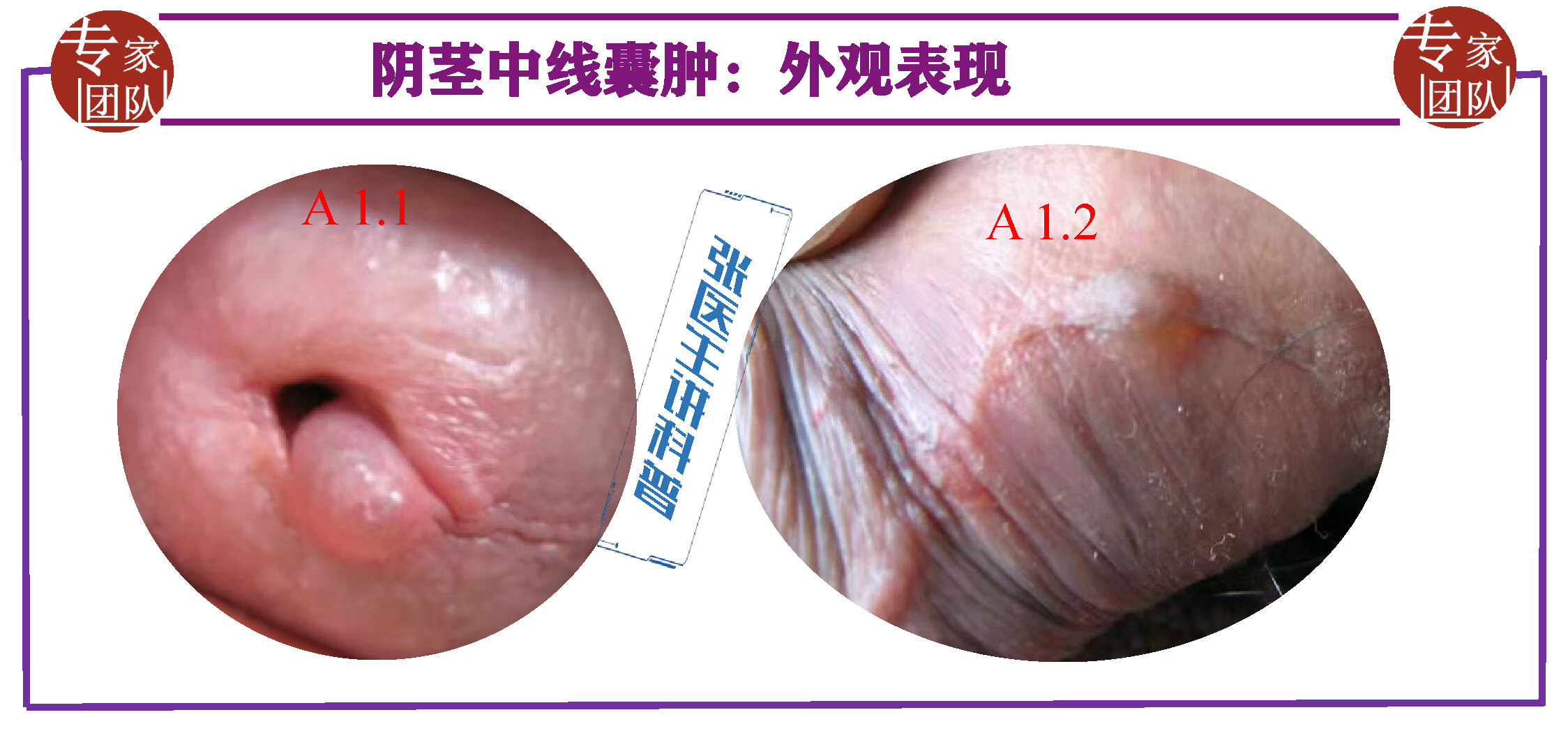 尿道外口及会阴生殖器中线上的水泡 需考虑 阴茎中线囊肿 好大夫在线 尿道外口及会阴生殖器中线上的水泡 需考虑 阴茎中线囊肿 好大夫在线