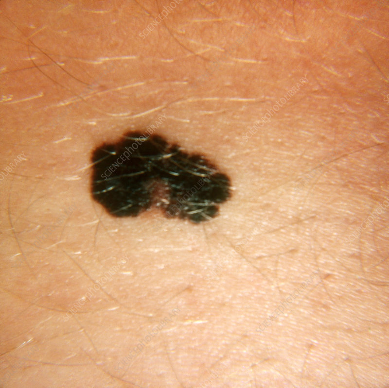 C0222147-Malignant_Melanoma.jpg