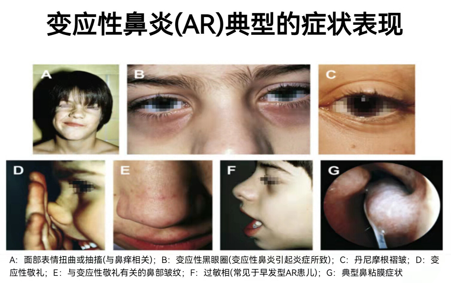 各种鼻炎的症状图片图片