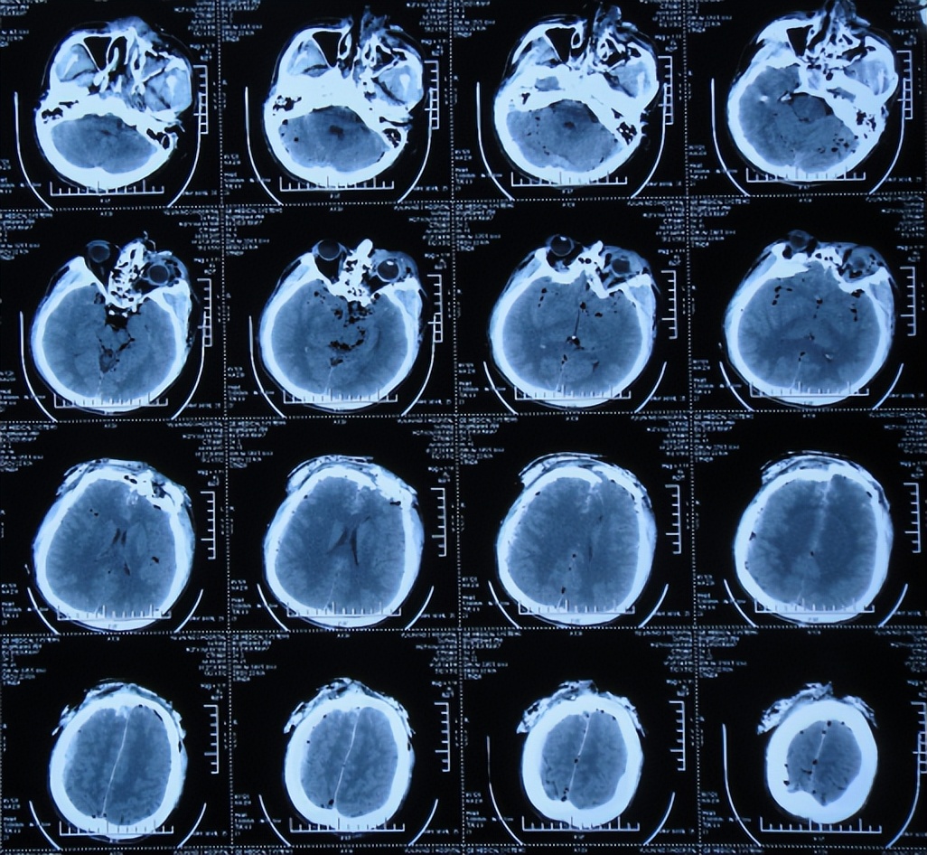 特重开放性颅脑损伤昏迷严重脑脊液鼻漏硬膜下积液脑积水颅内严重感染