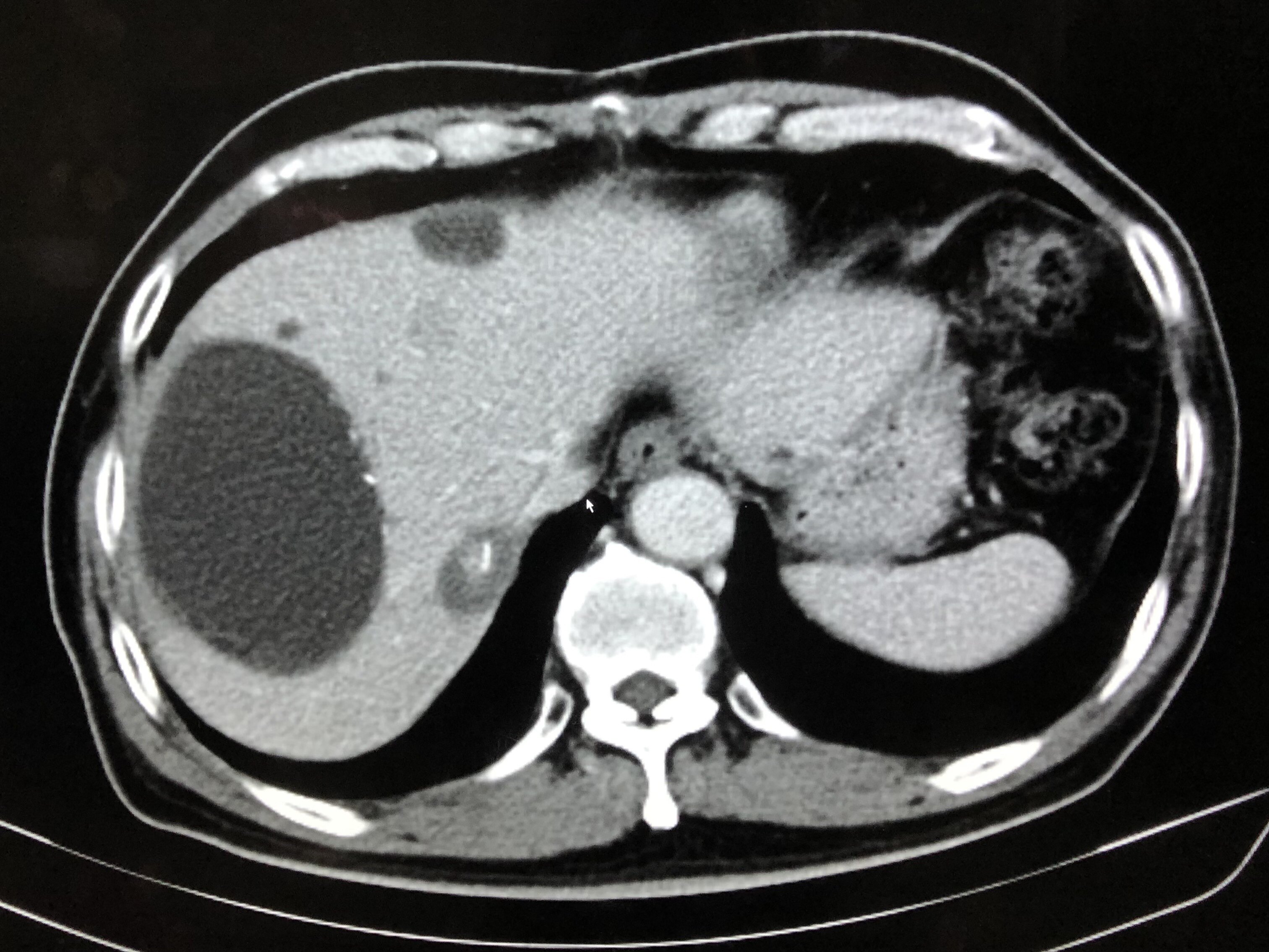 肝肿瘤ct显示图片图片
