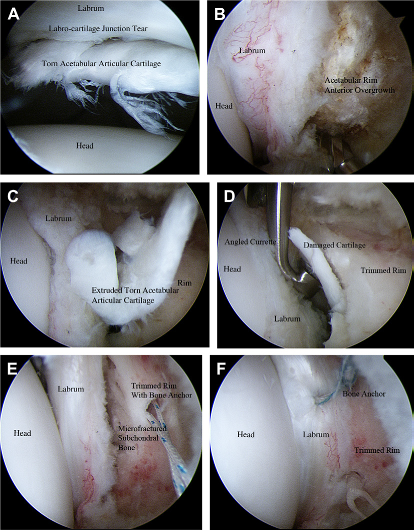 (a) arthroscopic view of right hip showing torn acetabular