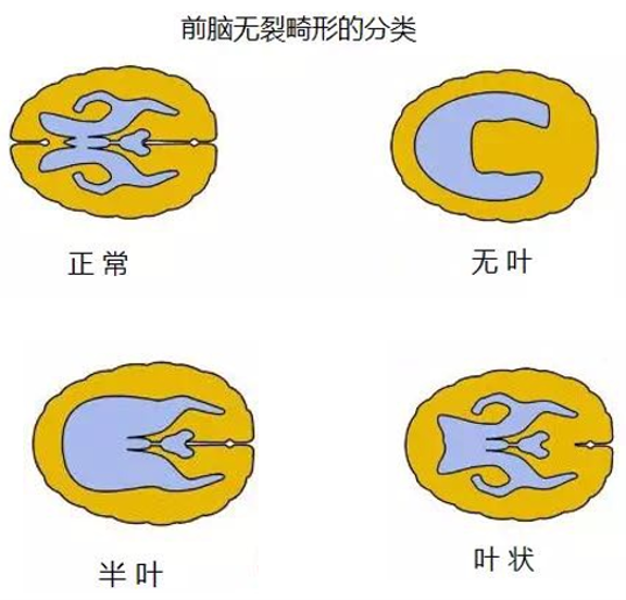 全前脑畸形_颅脑先天畸形_颅脑先天畸形相关疾病 - 好大夫在线